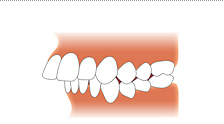 上顎前突画像