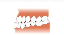 反対咬合画像