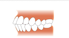 上下顎前突画像
