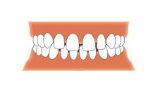 空隙歯列画像